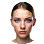 files/acne-free-mobile.png