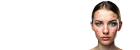 files/acne.png