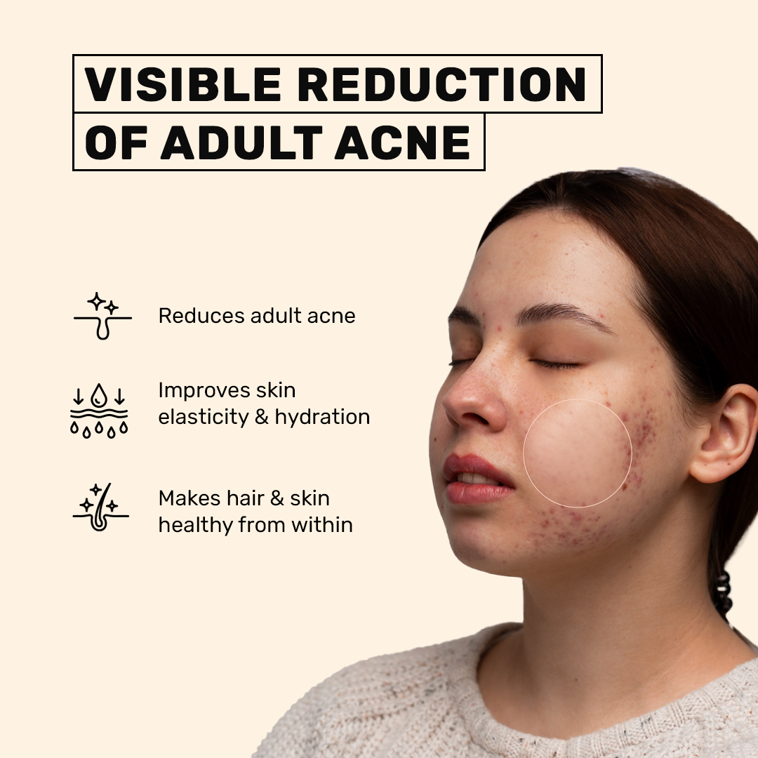 Anti-Acne Collagen